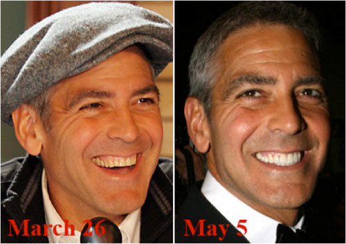 Faccette in ceramica - George Clooney