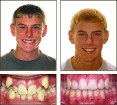 Ortodonzia adolescenti 2