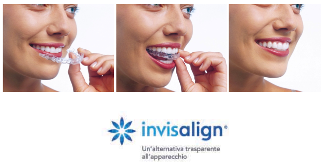 Ortodonzia invisibile