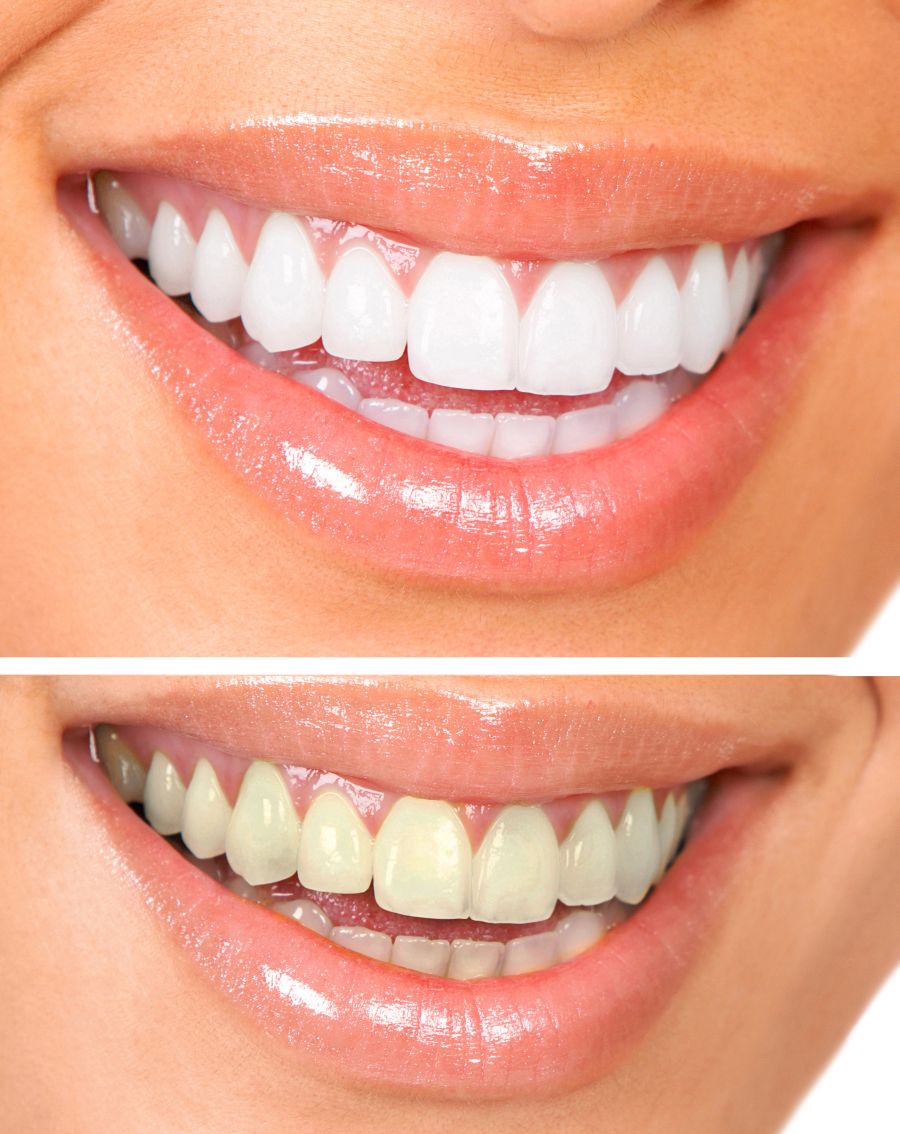 Sbiancamento dei denti