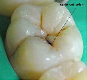 Sigillatura dei denti